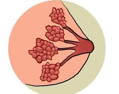 乳腺增生到底要不要治疗?(图1) 乳腺增生到底要不要治疗?(图1)